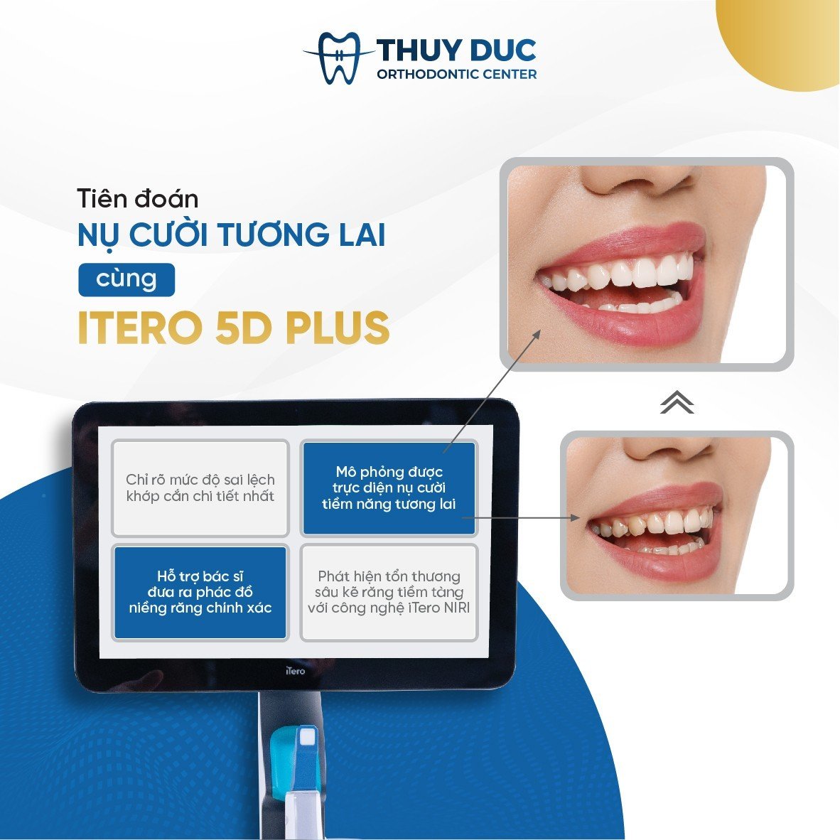 Tìm hiểu máy lấy dấu răng iTERO 5D PLUS tại nha khoa Thúy Đức 1 Tìm hiểu máy lấy dấu răng iTERO 5D PLUS tại nha khoa Thúy Đức 1