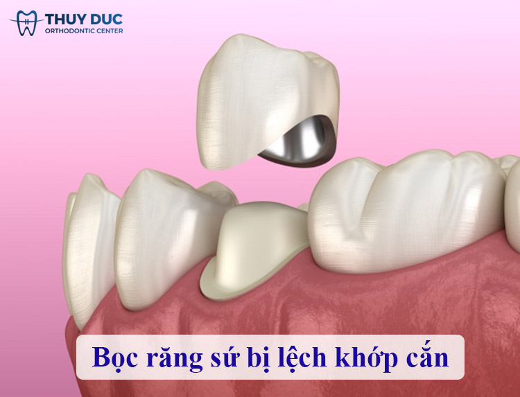 Bọc răng sứ bị lệch khớp cắn phải làm sao? 1