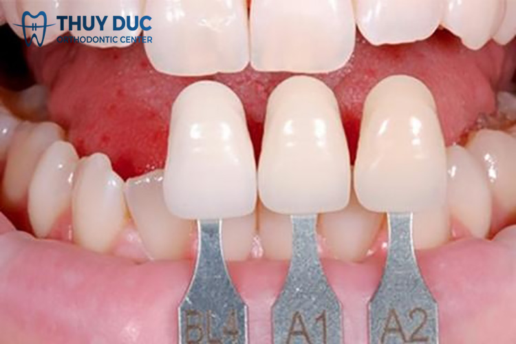 Nhổ răng kẹ thừa rồi bọc răng sứ 1 Nhổ răng kẹ thừa rồi bọc răng sứ 1