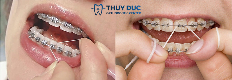 Cách dùng chỉ nha khoa cho người mới 2 Cách dùng chỉ nha khoa cho người mới 2