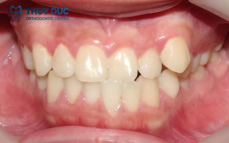 Khớp cắn chéo là gì? Có biểu hiện như thế nào? 1