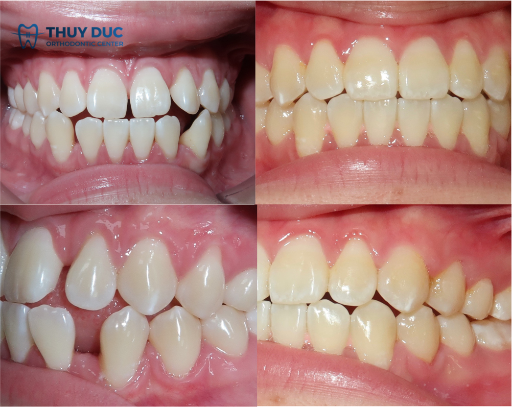 Kết quả niềng răng khớp cắn đối đầu tại Nha khoa Thúy Đức 1
