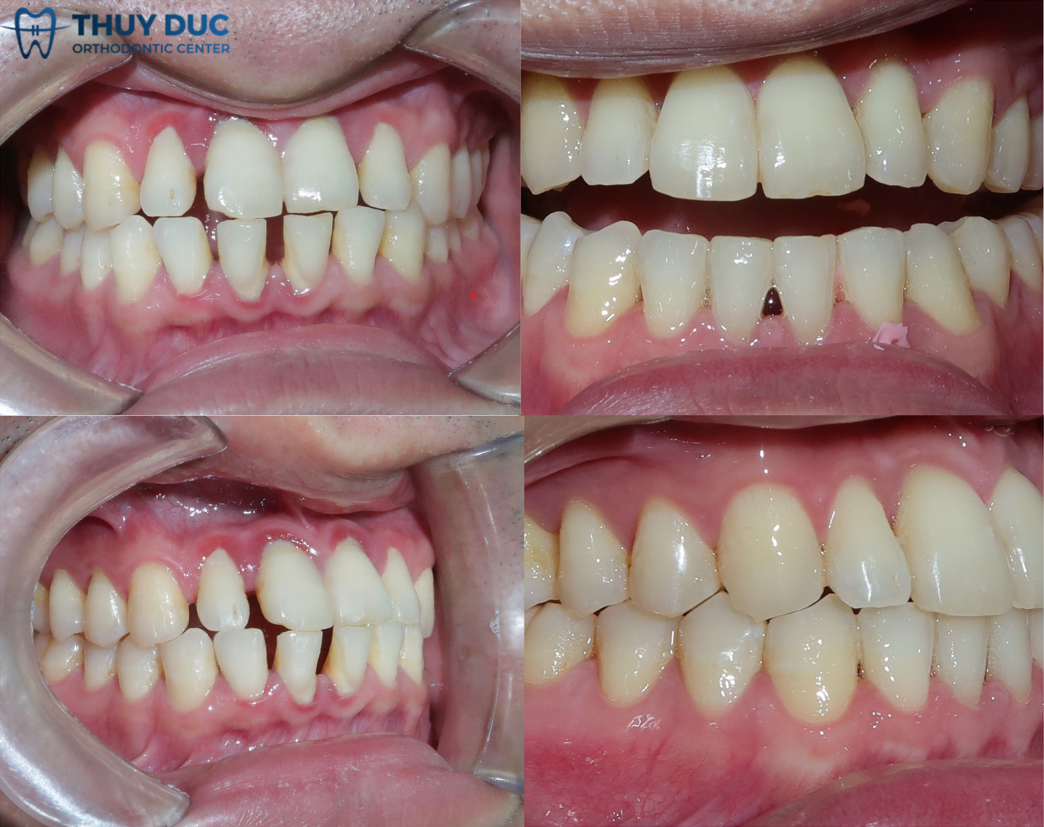 Kết quả niềng răng khớp cắn đối đầu tại Nha khoa Thúy Đức 2