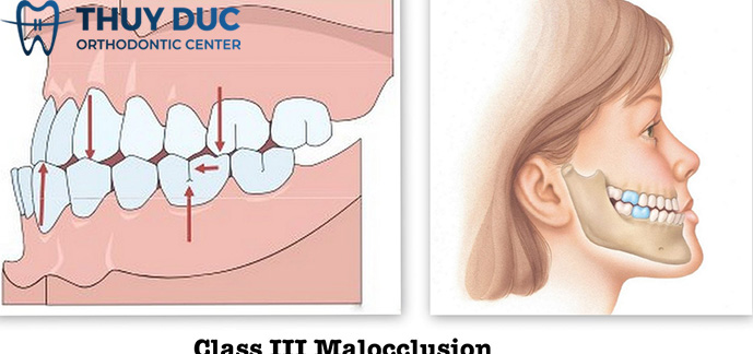 Vai trò của khí cụ chỉnh nha facemask 1 Vai trò của khí cụ chỉnh nha facemask 1