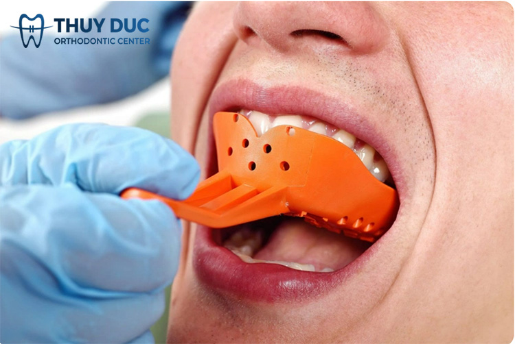 Lấy dấu cùi răng và gắn răng tạm 1