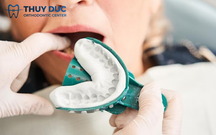 Khi nào cần lấy dấu răng? 1 Khi nào cần lấy dấu răng? 1