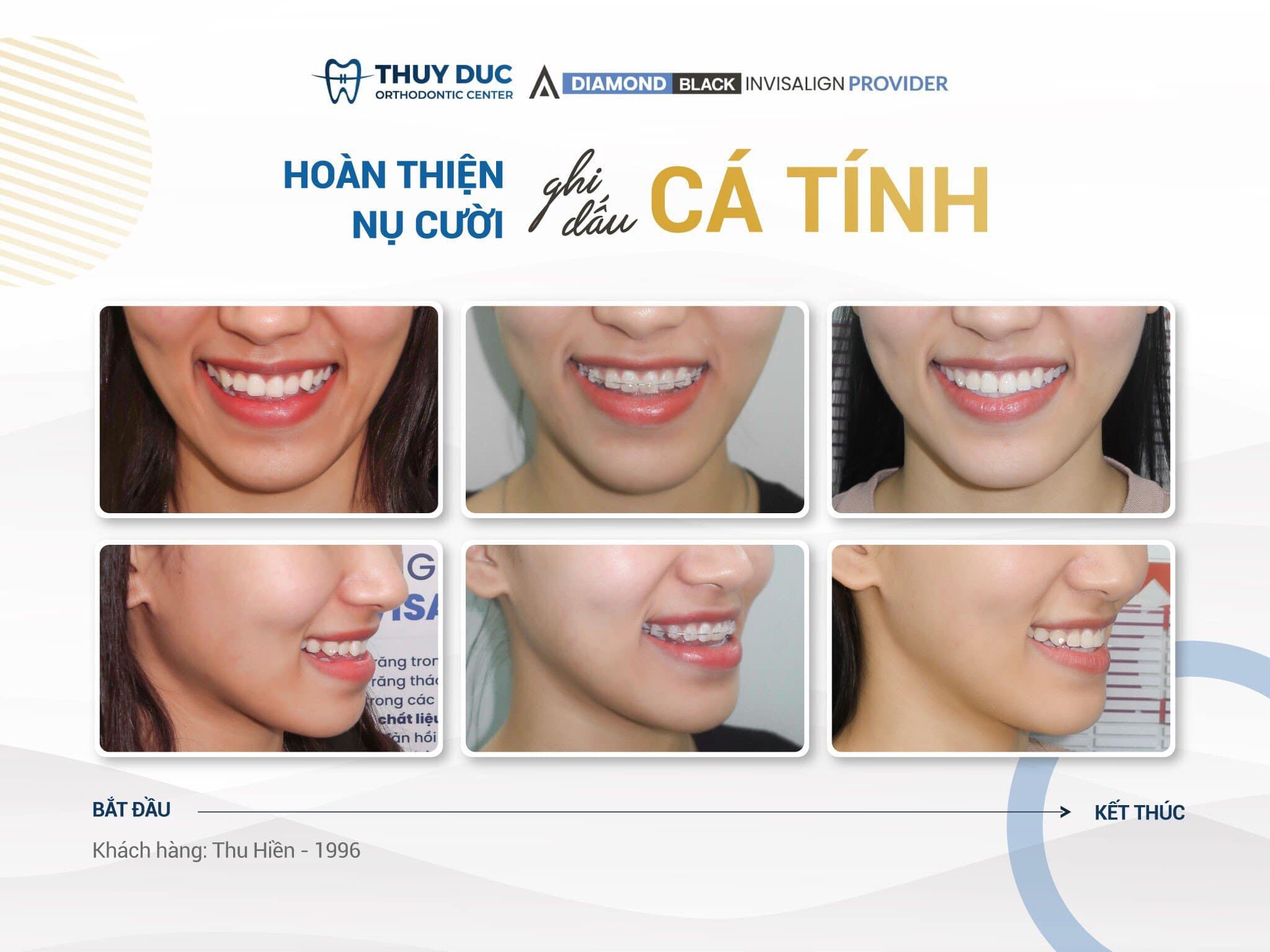 Niềng răng 1 Niềng răng 1