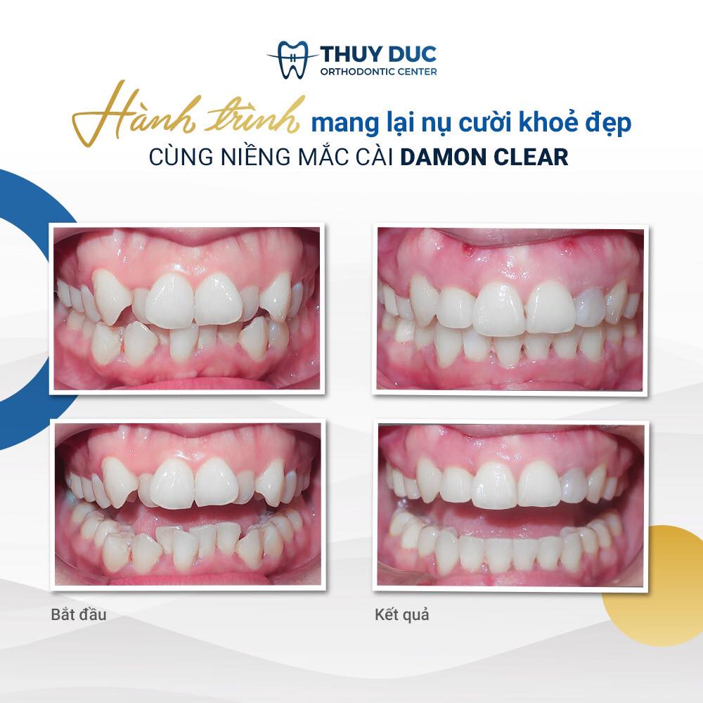 Tình trạng răng 1 Tình trạng răng 1