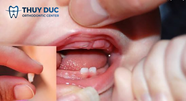 Răng kẹ ở trẻ em nên xử lý thế nào? 1 Răng kẹ ở trẻ em nên xử lý thế nào? 1