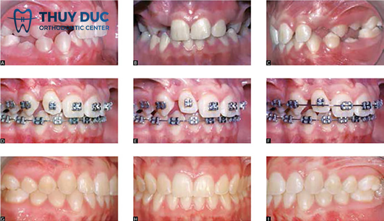 Niềng răng có những giai đoạn nào? 1 Niềng răng có những giai đoạn nào? 1