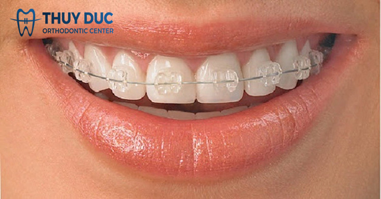 Nhổ răng kẹ thừa rồi niềng răng 2 Nhổ răng kẹ thừa rồi niềng răng 2