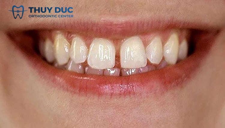 Nhổ răng kẹ thừa rồi niềng răng 1 Nhổ răng kẹ thừa rồi niềng răng 1