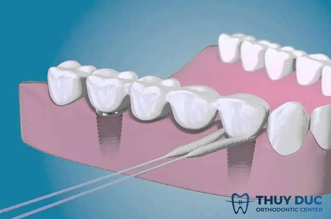 Các loại chỉ nha khoa 2 Các loại chỉ nha khoa 2