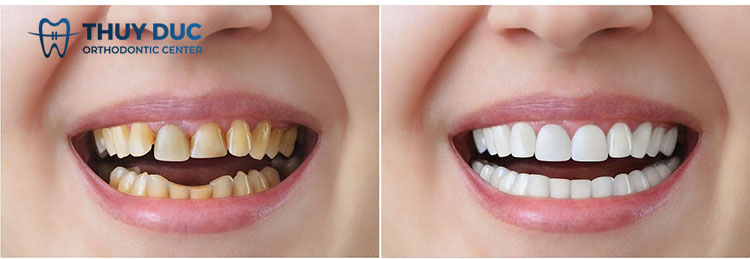 Có nên mài răng vẩu không? 2 Có nên mài răng vẩu không? 2