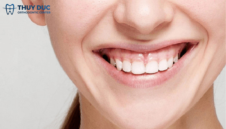 Cười hở lợi 1 Cười hở lợi 1