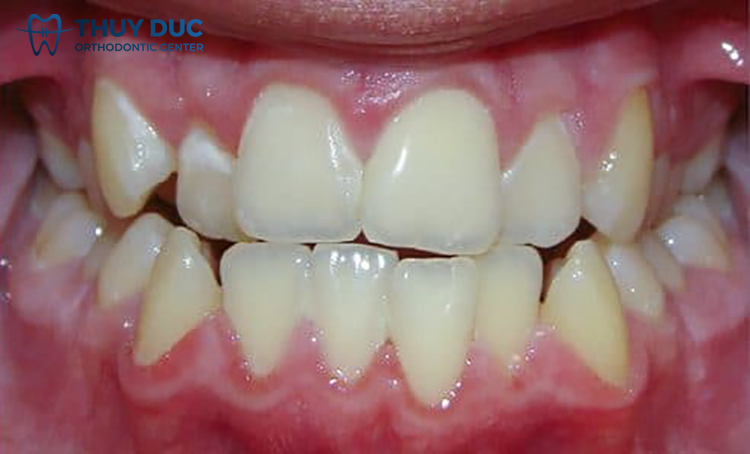 Phát triển hàm và răng không đồng đều 1