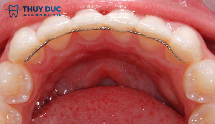 Hàm duy trì cố định là gì? 1 Hàm duy trì cố định là gì? 1