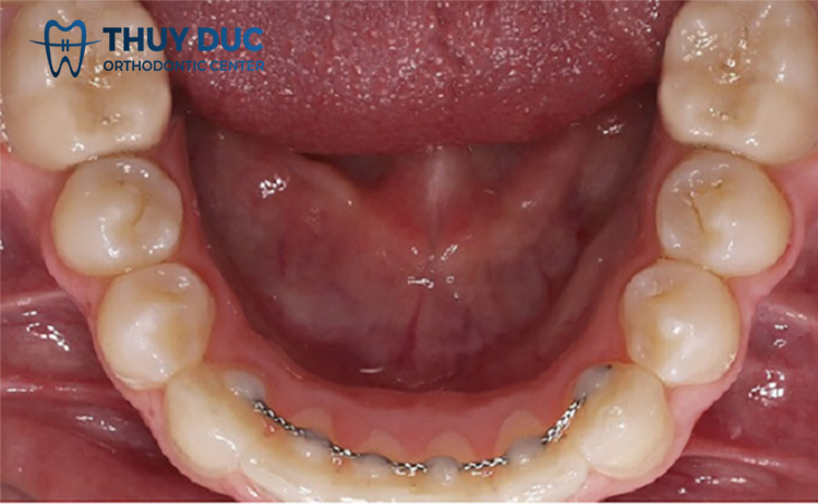 Ưu điểm của hàm duy trì cố định 1 Ưu điểm của hàm duy trì cố định 1