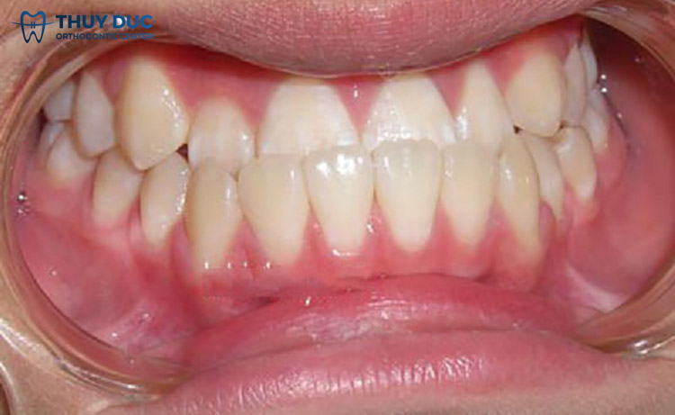 Răng móm - Underbite 1 Răng móm - Underbite 1