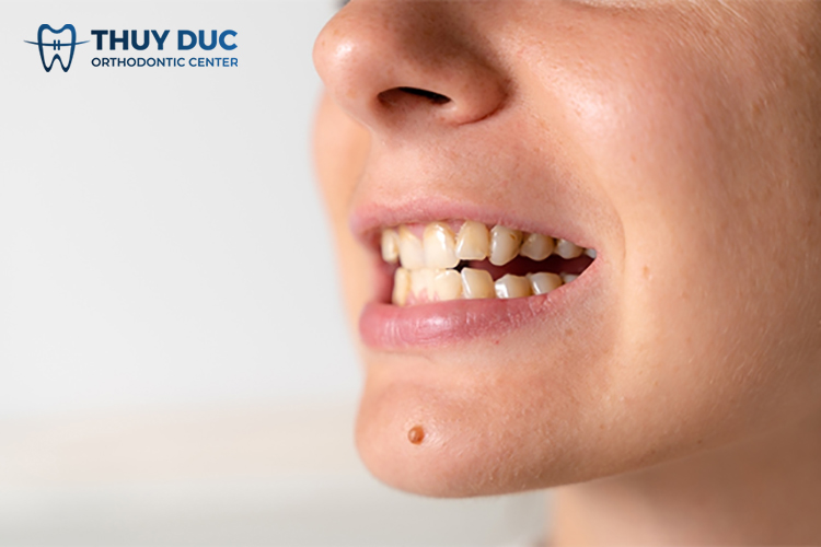 Khớp cắn đối đầu là gì? Điều trị như thế nào? 1