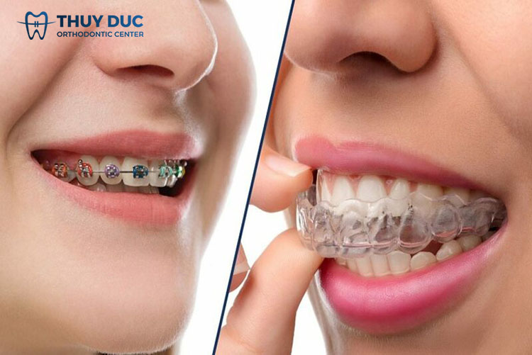 Cách điều trị răng hô hiệu quả 2 Cách điều trị răng hô hiệu quả 2