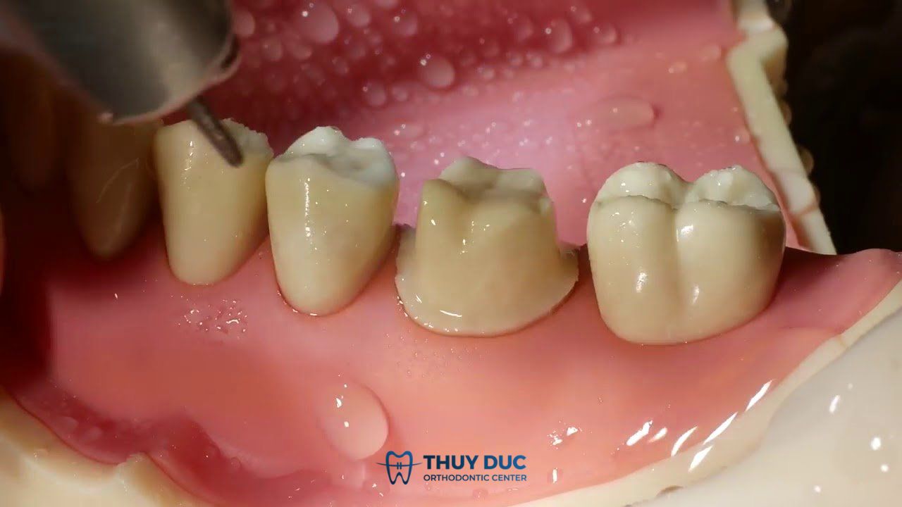 Mài răng sai tỷ lệ 1