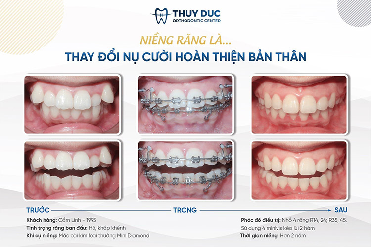 Niềng răng 1 Niềng răng 1