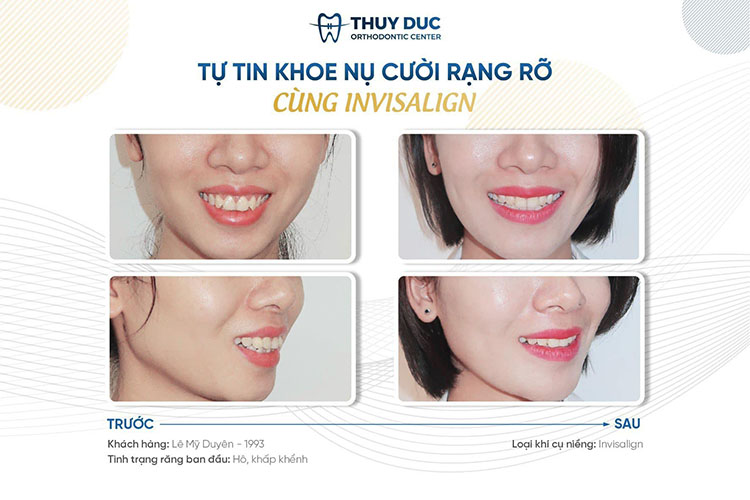 Niềng răng điều trị răng vẩu 1 Niềng răng điều trị răng vẩu 1