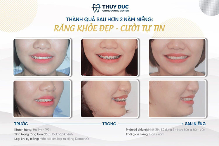 Cách điều trị răng hô hiệu quả 1 Cách điều trị răng hô hiệu quả 1