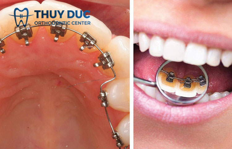 Niềng răng mắc cài mặt lưỡi là gì? 1