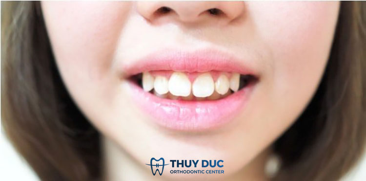 Xem tướng người răng hô về tiền tài 1 Xem tướng người răng hô về tiền tài 1