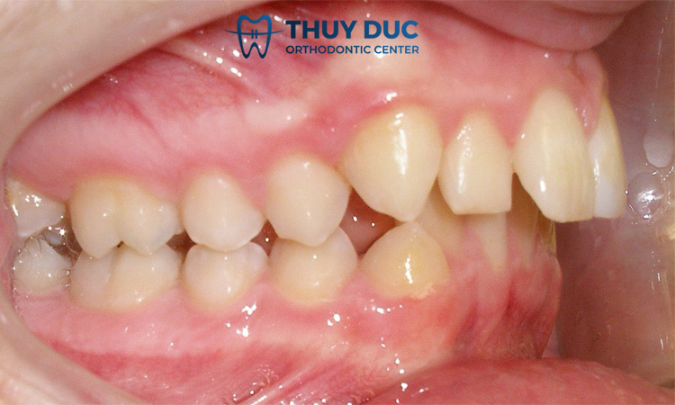 Xem tướng người răng hô về tình duyên 1 Xem tướng người răng hô về tình duyên 1