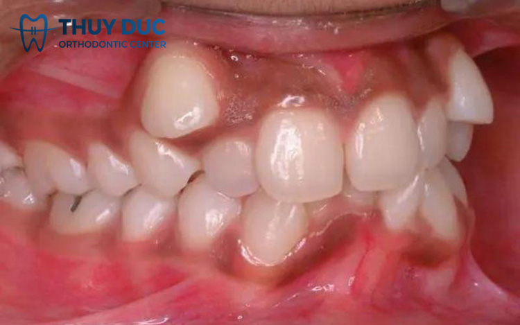 Răng mọc chồi: Nguyên nhân và cách xử lý 1