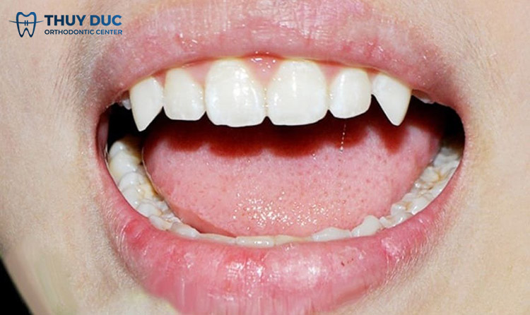 Răng quỷ 1 Răng quỷ 1