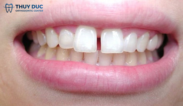 Răng thưa 1 Răng thưa 1