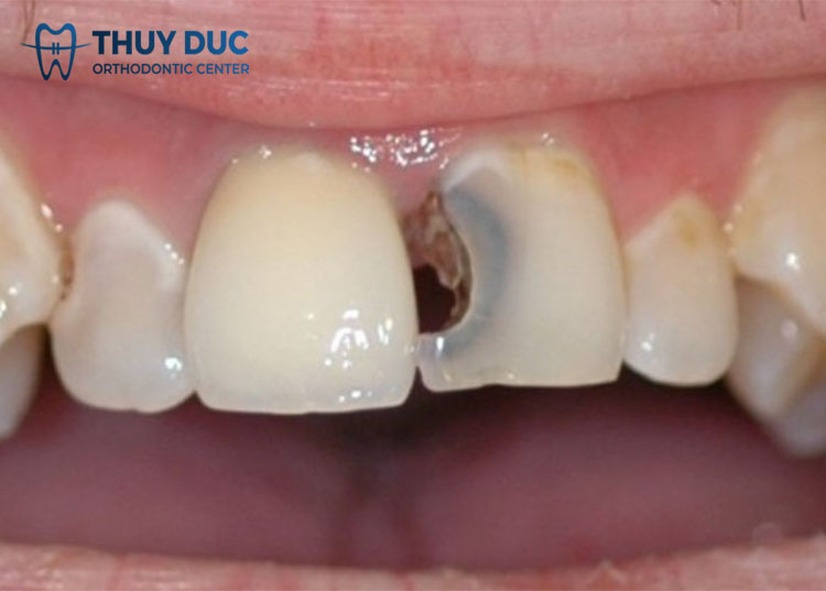 Dẫn đến một số bệnh lý răng miệng khác 1