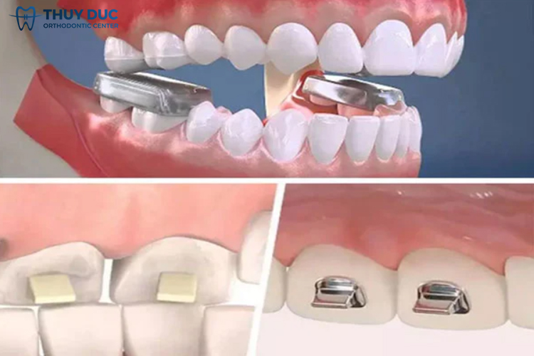 Tìm hiểu về cục nâng khớp cắn trong niềng răng 1 Tìm hiểu về cục nâng khớp cắn trong niềng răng 1