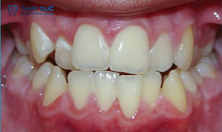 Khớp cắn đối đầu (edge-to-edge bite) 1 Khớp cắn đối đầu (edge-to-edge bite) 1