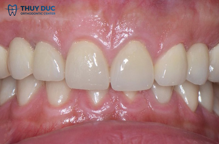 Khớp cắn sâu (Deep bite) 1 Khớp cắn sâu (Deep bite) 1