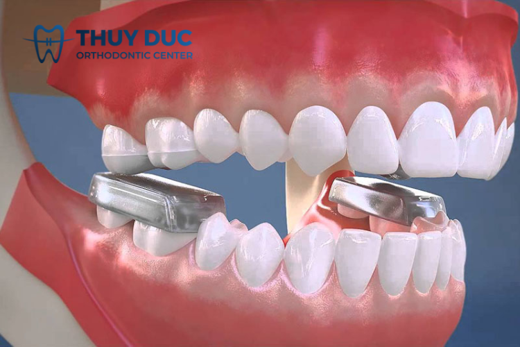 Cục nâng khớp cắn là gì? 1 Cục nâng khớp cắn là gì? 1
