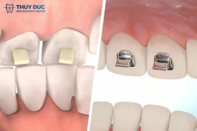 Nâng khớp cắn có mất thêm phí trong gói niềng không? 1 Nâng khớp cắn có mất thêm phí trong gói niềng không? 1