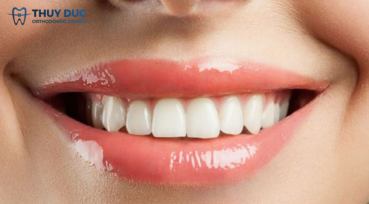 Tướng người có răng cửa to tốt hay xấu? 1 Tướng người có răng cửa to tốt hay xấu? 1