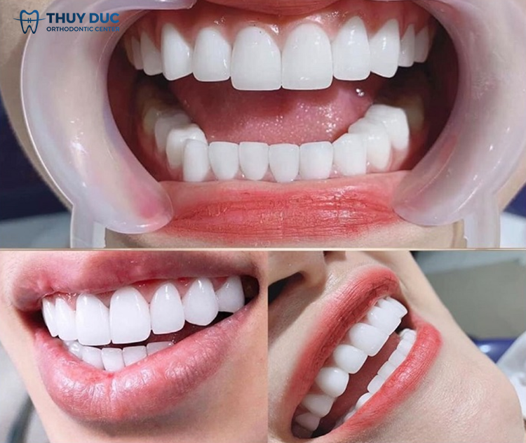 Bọc răng sứ 1 Bọc răng sứ 1