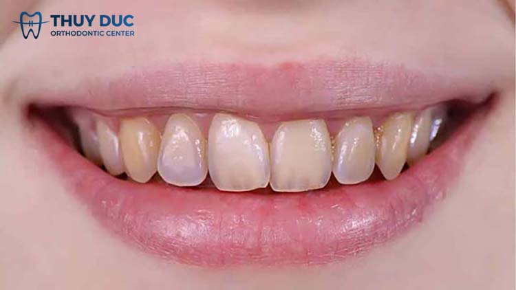 Tìm hiểu về men răng yếu bẩm sinh 1