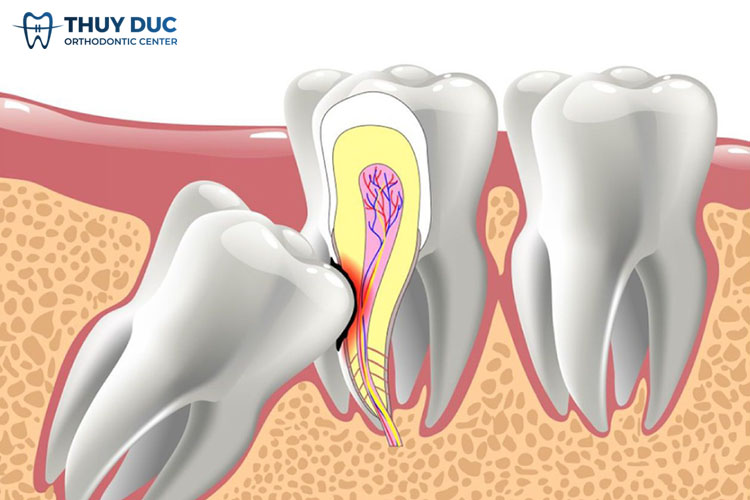 Ảnh hưởng tới dây thần kinh 1 Ảnh hưởng tới dây thần kinh 1