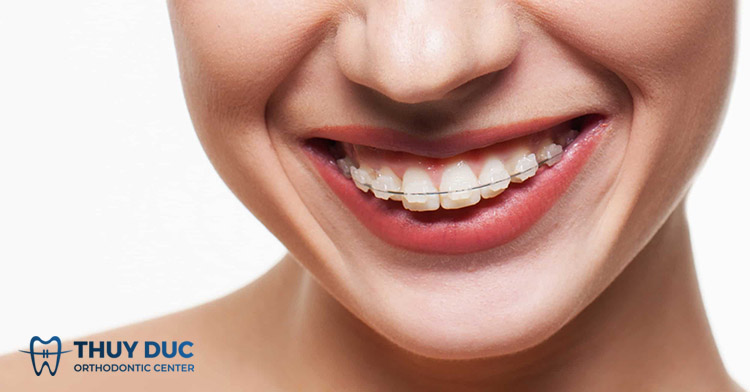 Phương pháp điều trị răng hô hiệu quả khác 1