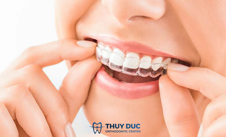 Niềng răng invisalign 1 Niềng răng invisalign 1