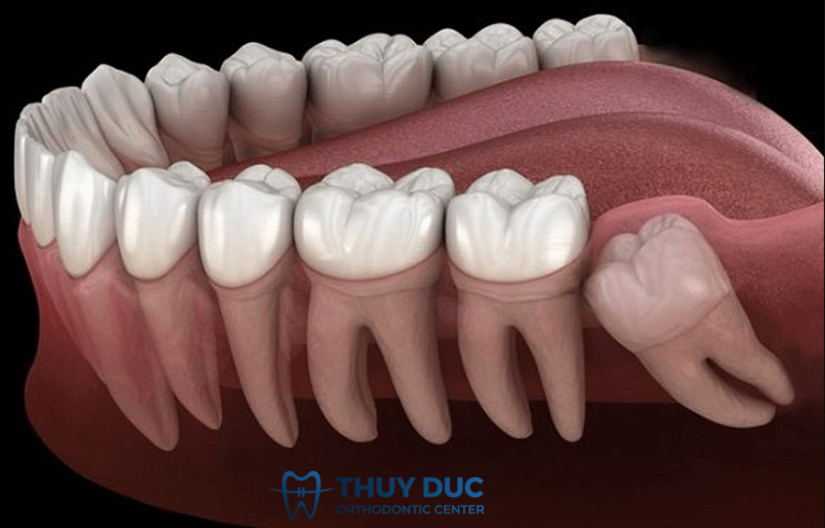 2. Dấu hiệu mọc răng khôn 1 2. Dấu hiệu mọc răng khôn 1