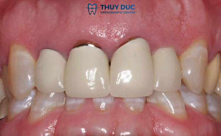 2. Bọc răng sứ có bị tụt nướu không? 1 2. Bọc răng sứ có bị tụt nướu không? 1