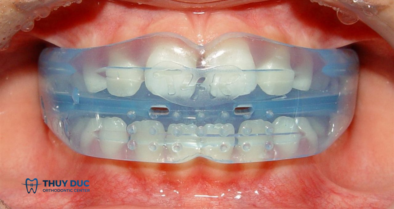 6. Mua niềng răng trainer a1 a2 a3 ở đâu? Giá bao nhiêu? 1
